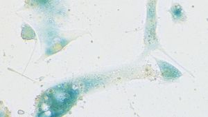 Zellen der menschlichen Nasenschleimhaut, die infolge einer SARS-CoV-2-Infektion das Seneszenzprogramm gestartet haben. Angefärbt wurden sie mit der „Seneszenz-assoziierten Beta-Galaktosidase-Färbung“, einem Standard-Nachweisverfahren für Seneszenz, das eine typische Blaufärbung erzeugt: Charité/Soyoung Lee 