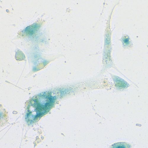 Human nasal mucosa cells that have started the senescence program resulting from a SARS-CoV-2 infection. They are stained with "senescence-associated beta-galactosidase staining", a standard method to detect senescence that produces commonly observed blue staining: Charité/Soyoung Lee 